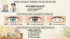 Cataracts and Senior Living: When Inoperable Vision Loss Limits Independence